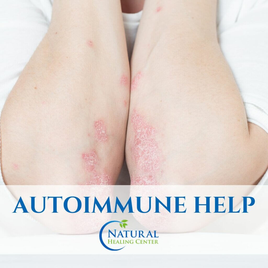 Autoimmune help with natural healing remedies in Newport Beach, California.